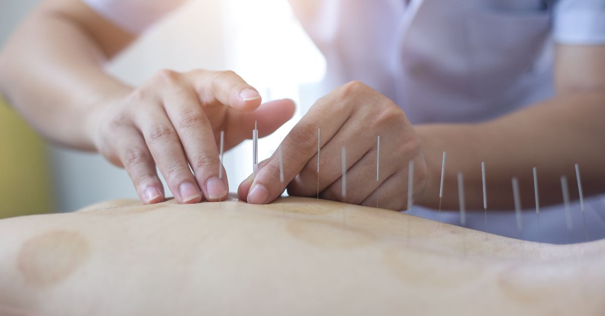 What is the Average Cost of Acupuncture Treatments in the US?